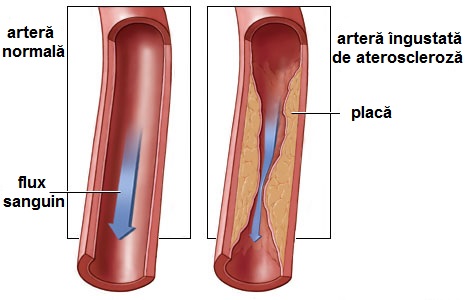articulațiile aterosclerozei doare