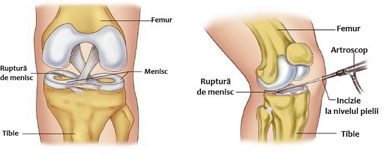 Meniscus fisură de genunchi tratament articulației)