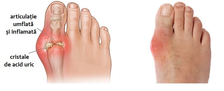 inflamația articulară pe degetul piciorului)